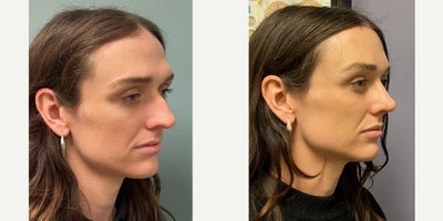 Brow Lift before and after photo