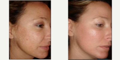 Laser Resurfacing before and after photo