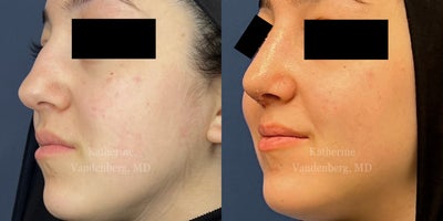 Rhinoplasty before and after photo