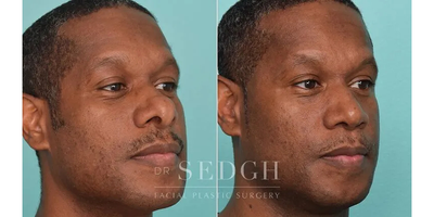 African American Rhinoplasty before and after photo