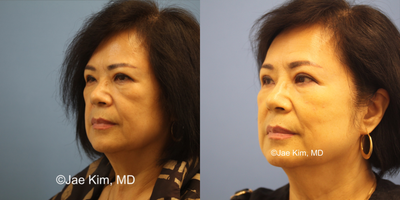 Cheek Fillers before and after photo