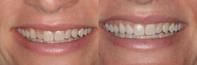 Dental Bonding before and after photo