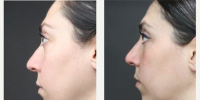 Eyelid Surgery before and after photo