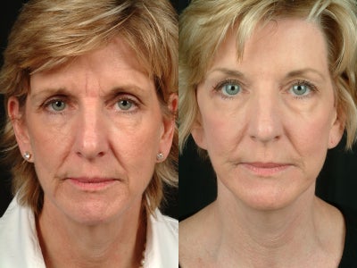 Facelift before and after photo