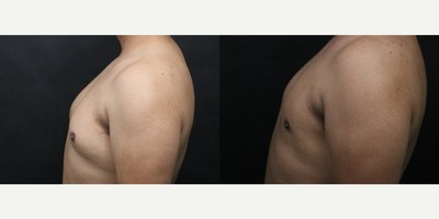 Gynecomastia Surgery before and after photo