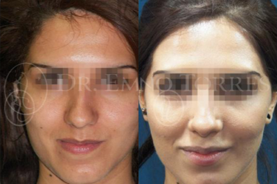 Rhinoplasty before and after photo
