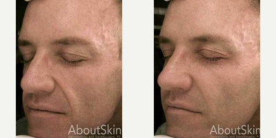 Sculptra before and after photo