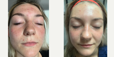 YAG Laser before and after photo