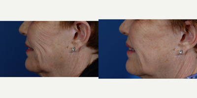 Botox before and after photo