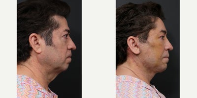Brow Lift before and after photo