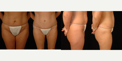 Tummy Tuck before and after photo