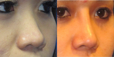Asian Rhinoplasty before and after photo