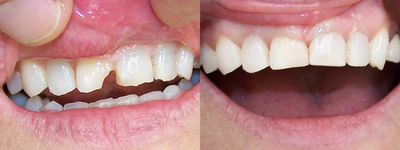 Dental Bonding before and after photo