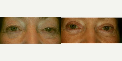 Eyelid Surgery before and after photo