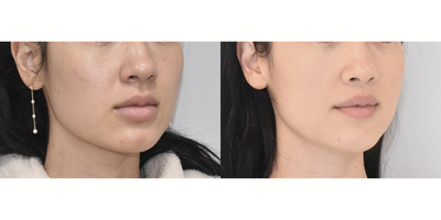 Lip Lift before and after photo