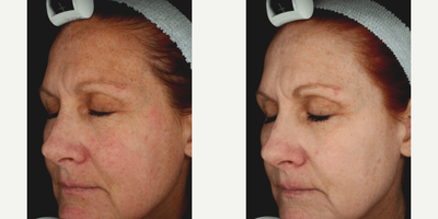 PicoSure before and after photo