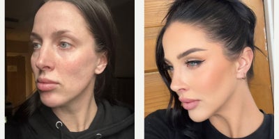 Revision Rhinoplasty before and after photo