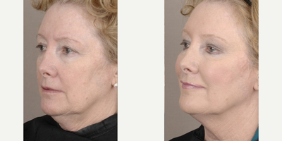 Cheek Fillers before and after photo