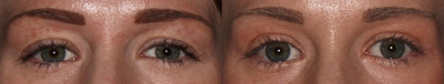 Eyelid Surgery before and after photo