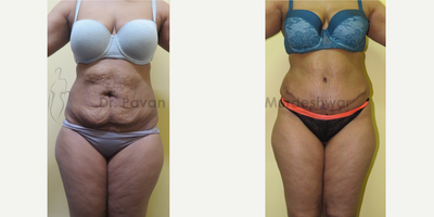 Tummy Tuck before and after photo