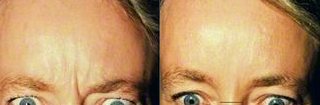 Botox before and after photo