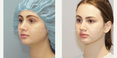 Buccal Fat Removal before and after photo