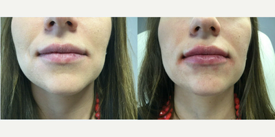 Restylane before and after photo