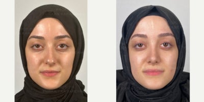 Rhinoplasty before and after photo