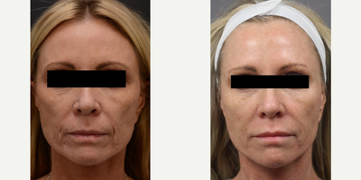 Sculptra before and after photo