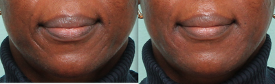 Belotero before and after photo