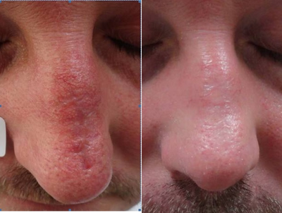 Fraxel Repair before and after photo