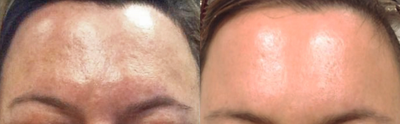 Laser Resurfacing before and after photo