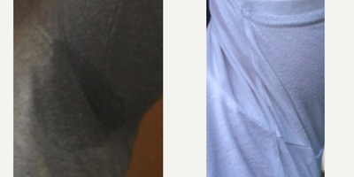 MiraDry before and after photo