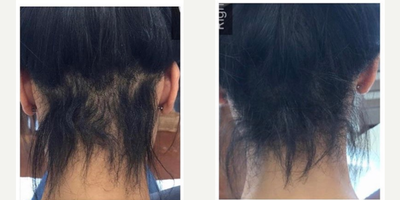 PRP for Hair Loss before and after photo