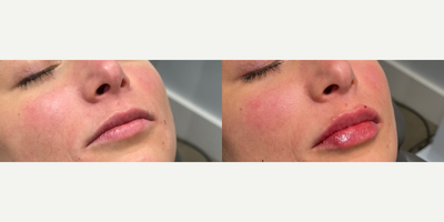 Revanesse before and after photo