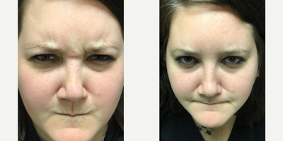 Botox before and after photo