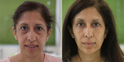 Dermal Fillers before and after photo