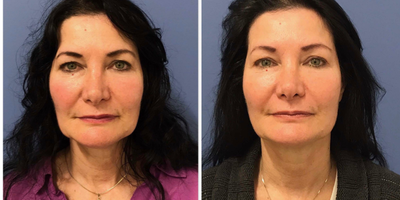 Kybella before and after photo