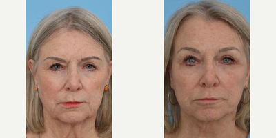 Restylane before and after photo