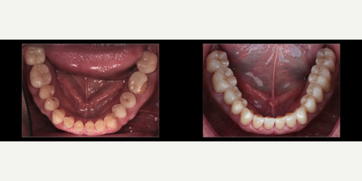 Smile Makeover before and after photo