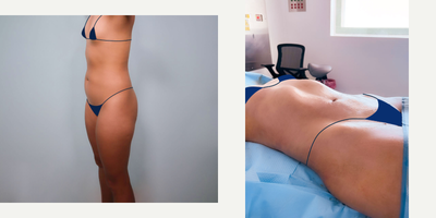 BodyTite before and after photo