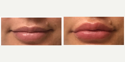 Dermal Fillers before and after photo