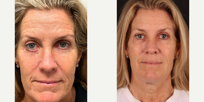 Facelift before and after photo