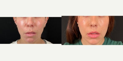 Lip Lift before and after photo