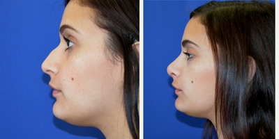 Rhinoplasty before and after photo