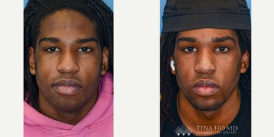 Rhinoplasty before and after photo