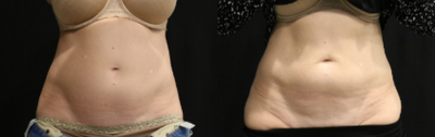 CoolSculpting before and after photo