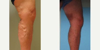 EVLT before and after photo