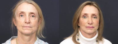 Facelift before and after photo