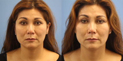 Dermal Fillers before and after photo